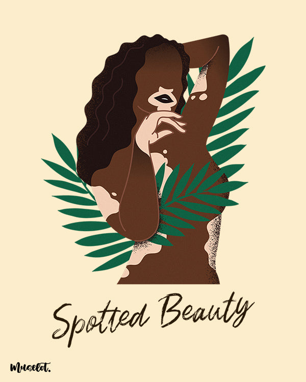 Spotted Beauty poster of a woman with vitiligo - Muselot